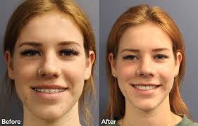 Does an underbite need to be corrected? Orthognathic Surgery All Alaska Oral Craniofacial Surgery