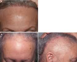hair loss springerlink