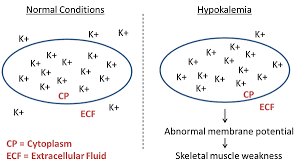 what is hypokalemia definition