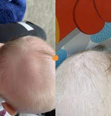 lump on baby s head babycenter