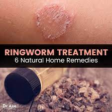 ringworm treatment try these 6 natural