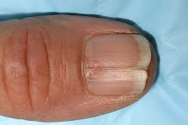 splitting nails cosmetic nail solutions