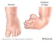 what-is-the-life-expectancy-of-someone-with-clubfoot