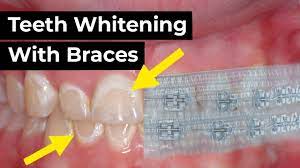 teeth whitening with braces you
