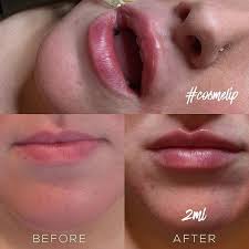 0 5ml and 1ml lip fillers injections