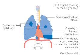What are the symptoms that occur. Lung Cancer Classification What Is Stage Iv Ponirevo