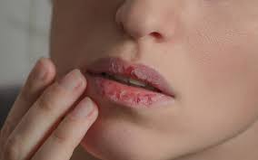 dry lips causes treatment