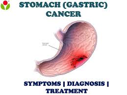 The first signs of stomach cancer are often vague. Ppt Stomach Gastric Cancer Overview Of Symptoms Diagnosis And Treatment Powerpoint Presentation Id 7557261