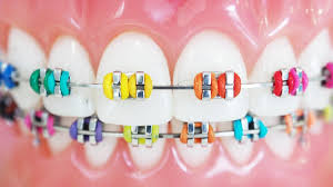 what braces colours to get how to pick
