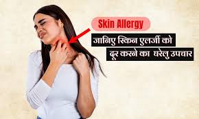 remove skin allergy with home remes