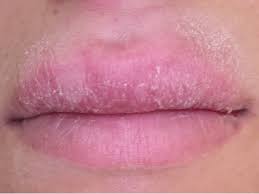 resolving of upper lip swelling after