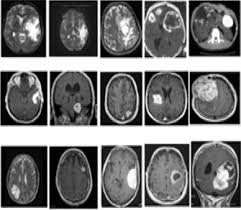 Identification And Classification Of Brain Tumor Mri Images