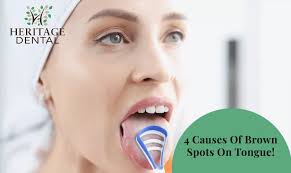 4 causes of brown spots on tongue