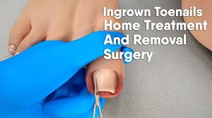 ingrown toenail home treatment and