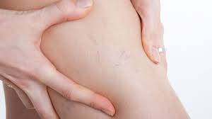 how to hide varicose veins 5 ways to