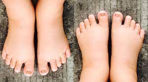 swollen feet during pregnancy edema