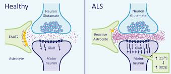 Als is characterized by a progressive degeneration of motor nerve cells in. Group 1 Presentation 1 Als Wiki