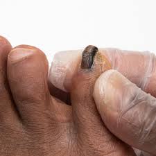 skin conditions nyota cal footcare