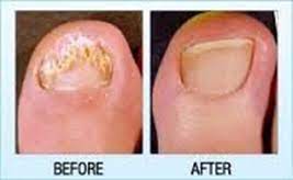 new toenail fungus laser removal your