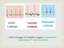 Exercise ecg testing has a relatively high sensitivity but only. Anaesthetic Management Of A Patient With Ischaemic Heart Disease