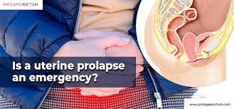 is a uterine prolapse an emergency