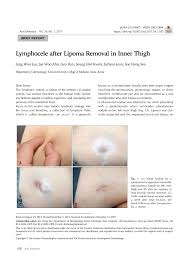 pdf lymphocele after lipoma removal in