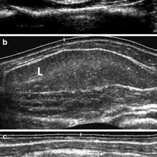 grey scale ultrasound of suascial