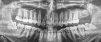 wisdom teeth removal banyo dental