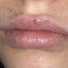 red dot on lip after lip filler still