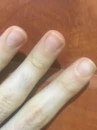 unexplained symptoms terrys nails b12