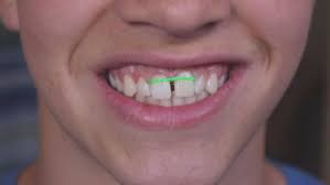 the danger of do it yourself braces