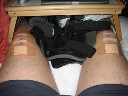 living with bilateral quadriceps
