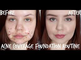 acne coverage foundation routine full