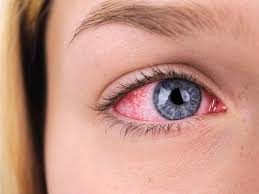 eyelid inflammation blepharitis
