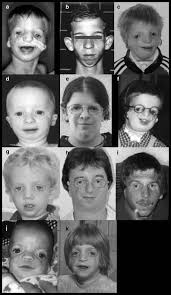 Treacher collins syndrome is a rare genetic condition that affects the development of the bones and tissues of the face. Genotyping In 46 Patients With Tentative Diagnosis Of Treacher Collins Syndrome Revealed Unexpected Phenotypic Variation European Journal Of Human Genetics