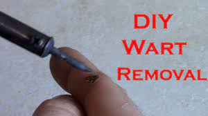 a wart at home with a soldering iron