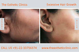 excessive hair growth removal treatment