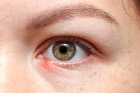 blepharitis eye home remes to treat it