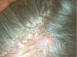seborrhoeic dermais scalp the