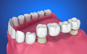 what is a fixed dental bridge konig