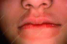skin irritation from constant lip