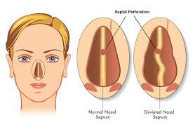 Septum synonyms, septum pronunciation, septum translation, english dictionary definition of septum. Nasal Septal Perforation Repair Dr Mourad Head And Neck Surgeon