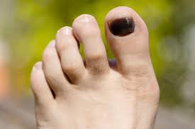 Not only does discoloration occur, but the nail will also usually be brittle and hard. Black Toenail 6 Potential Causes
