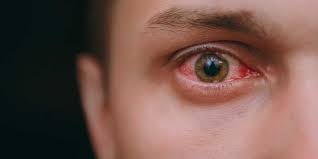 trustcare pink eye conjunctivitis