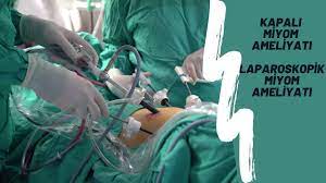 Laparoskopi ile Kapalı Miyom Ameliyatı Nasıl Yapılır? I Laparoskopik  Myomektomi - YouTube