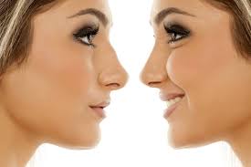 how a rhinoplasty can change your nose
