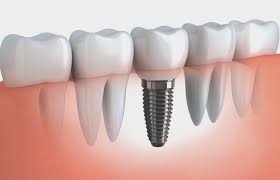 full mouth implants cost