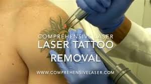 best laser tattoo removal baltimore