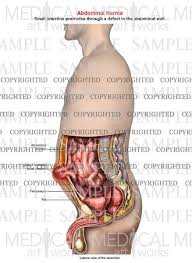Velg blant mange lignende scener. Abdominal Hernia Anatomy Of Male Lateral Single View Medical Art Works