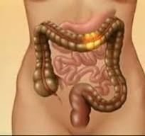 Síndrome de intestino irritable - Síntomas y causas - Mayo ...